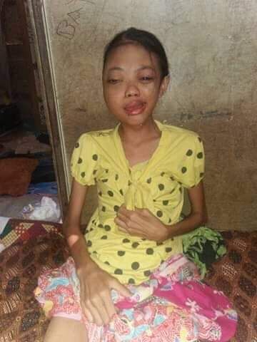 Monika Pengidap Kanker di Kabupaten Tanjabtimur
